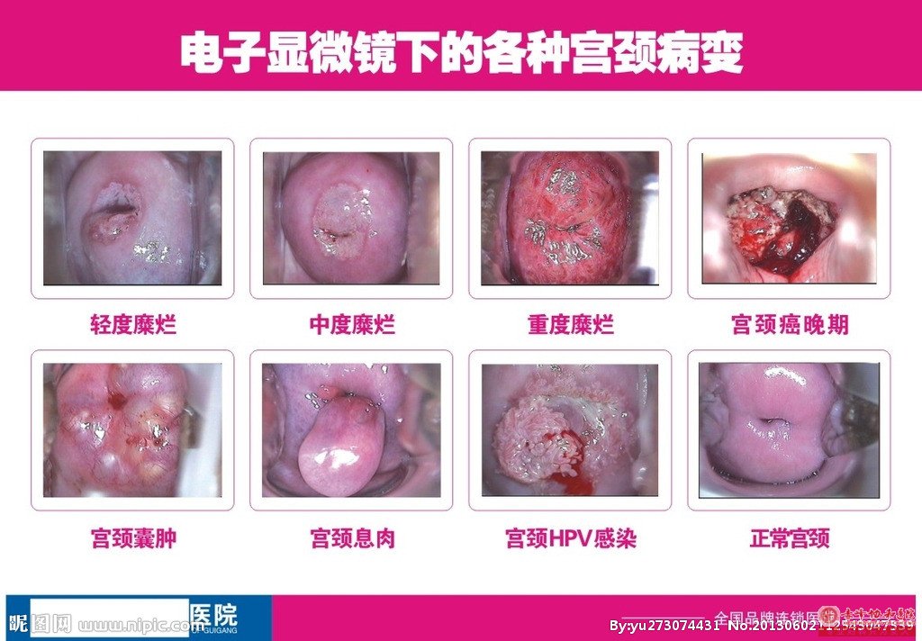 金华宫颈肥大要做哪些检查?