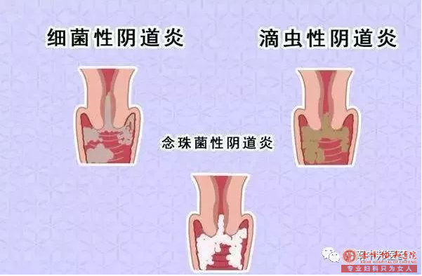 金华滴虫性阴道炎就是一个毛滴虫造成的?