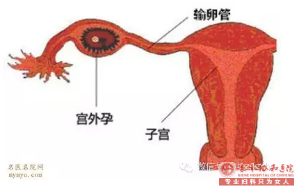 喀喇沁旗宫外孕有哪些症状?宫外孕要怎么治疗