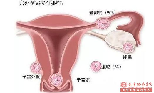 翁牛特旗宫外孕的早期有些什么样的症状?