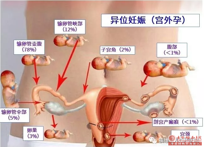 金华敖汉旗宫外孕的早期症状是什么?试纸能测出吗?